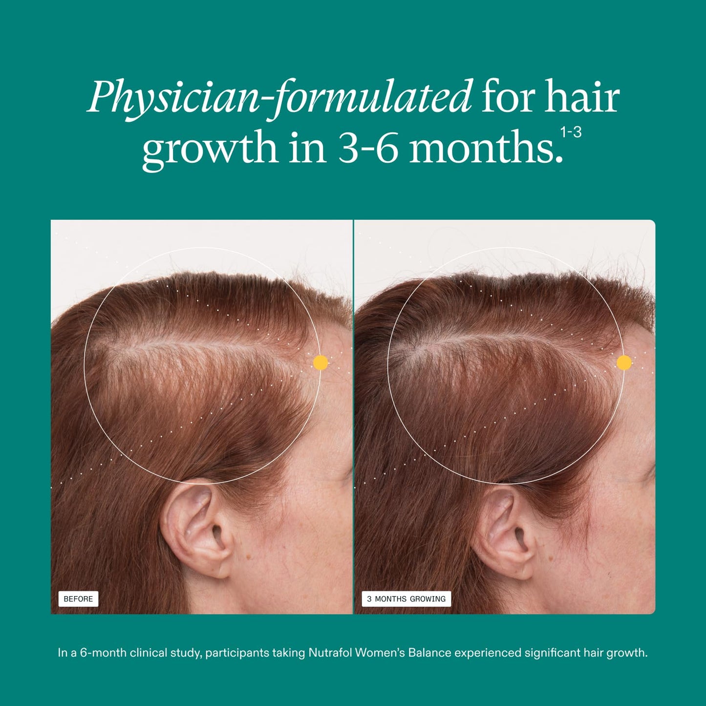 Nutrafol Women's Balance Hair Growth Supplements, Ages 45 and Up, Clinically Tested for Visibly Thicker Hair and Scalp Coverage