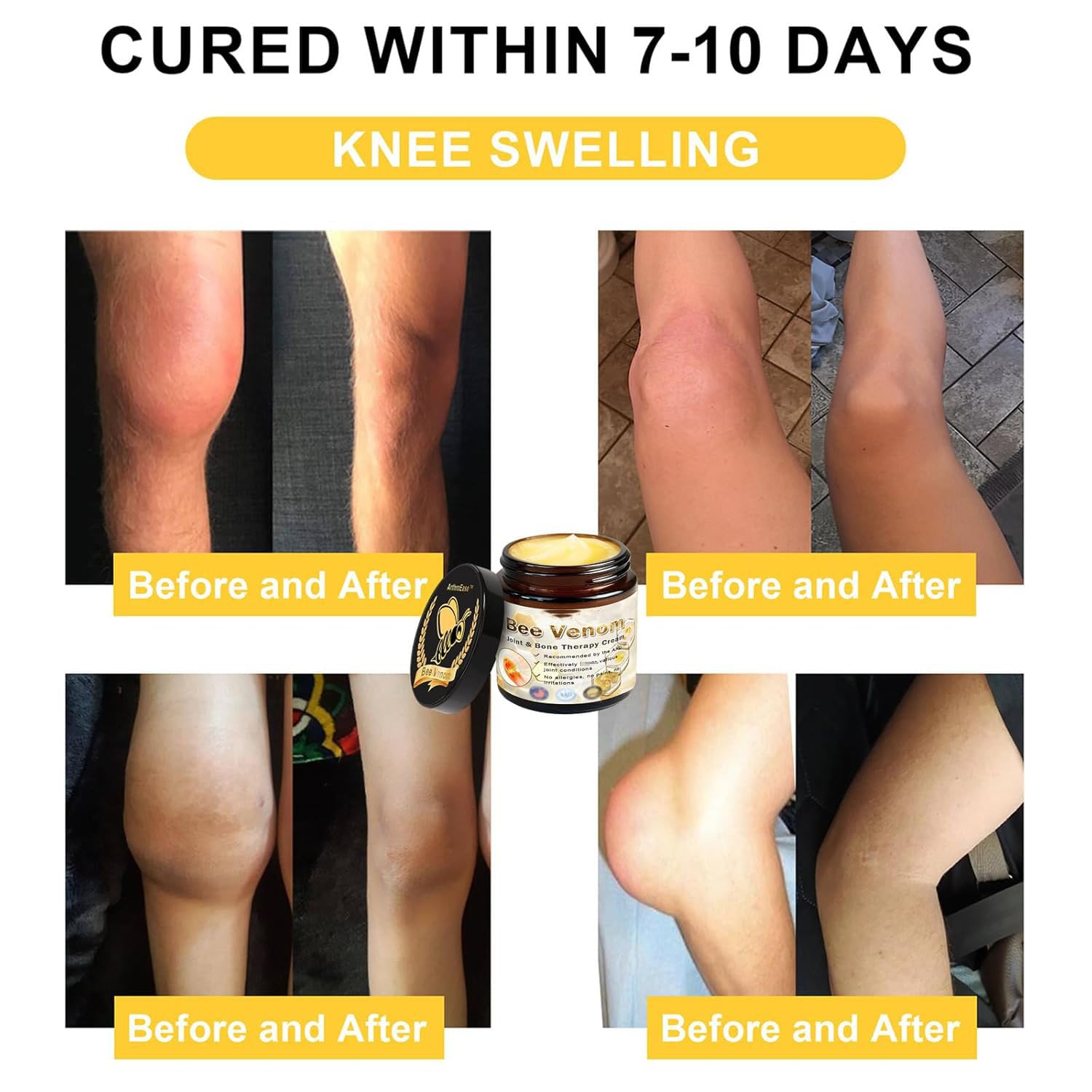 ArthroEase Bee Venom Arthritis Cream, Joint & Muscle Soothing Bee Venom Cream, Professional Bee Venom Joint Cream, Bee Venom Joint Gel - Specially for for Back, Neck, Hands, Knee (2 Bottle) - dailyvitalstore