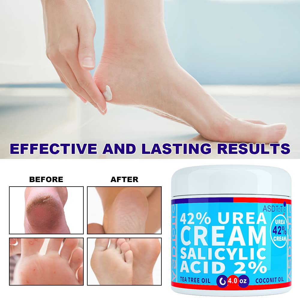 ASDToTio Urea Cream 42% - Premium Urea Foot Cream - With 2% Salicylic Acid, Tea Tree Oil, Shea Butter, Aloe Vera - For Feet, Hands, Heels, Elbows, Knees and More - 4 oz - dailyvitalstore