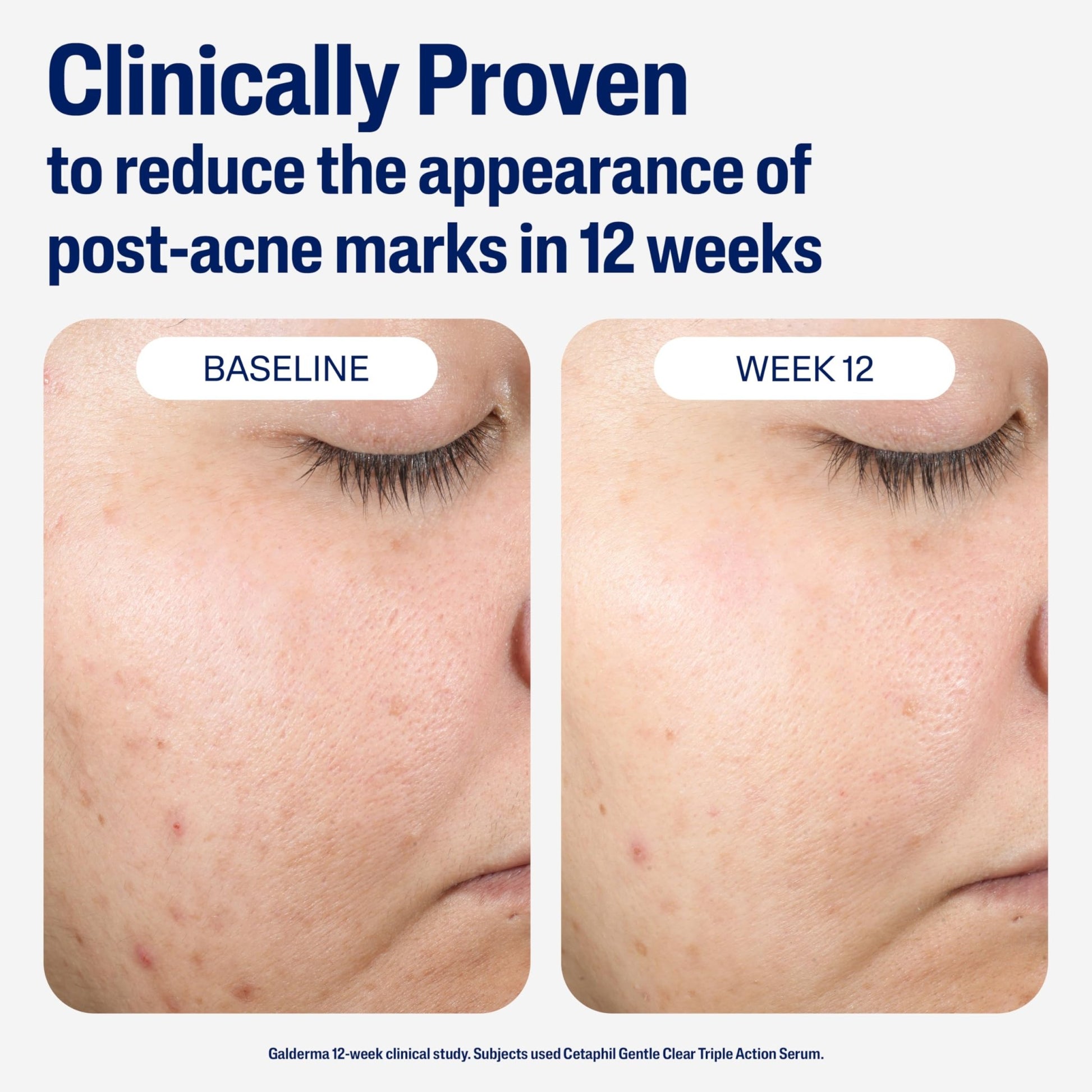 CETAPHIL Gentle Clear Repairing Post-Acne Serum, Retinol Alternative, Oil Free Serum for Sensitive Skin, 1 Fl Oz, Bakuchiol, Improves Skin Tone & Post-acne Marks, - dailyvitalstore