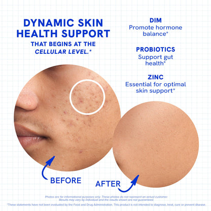 Clear Skin Supplement with Zinc, DIM & Probiotics | 3-in-1 Balance, Glow & Health Skin Support | Triple Action Hyaluronic Acid, Niaciminide & Vitamins for Hormone, Complexion & Gut Support | 180 Ct - dailyvitalstore
