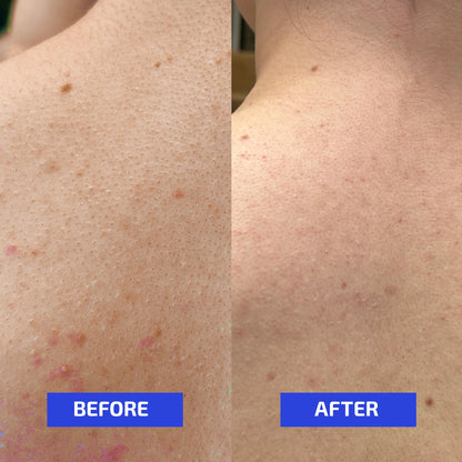 Codex Labs Shaant Clear Skin Supplement – 60 Vegan Capsules | Acne Probiotics with 9-Strain Blend, Green Tea EGCG & Guggul – Daily Support for Acne-Prone Skin & Clear Complexion - dailyvitalstore