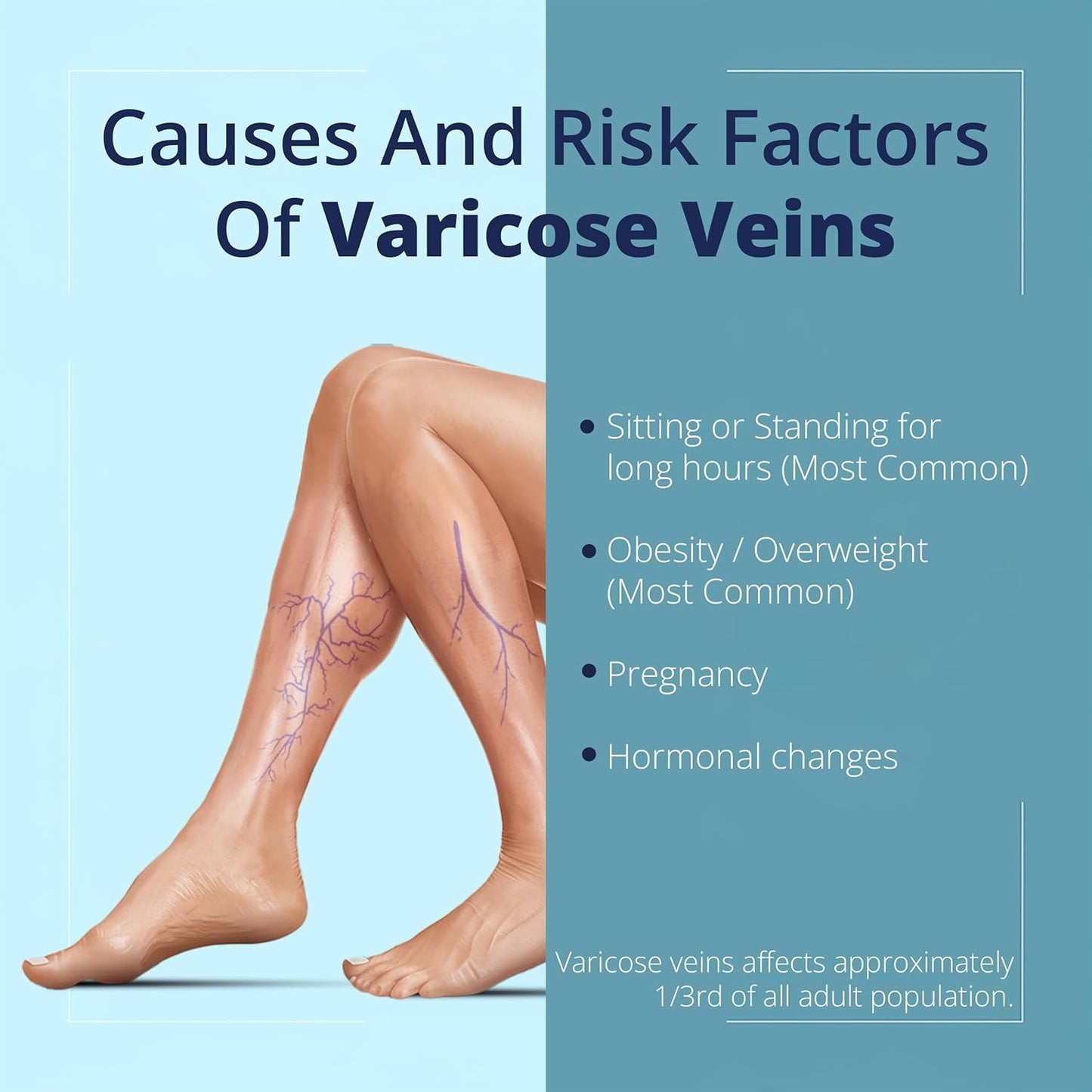 Cream Ayurvedic Solution for Management of Varicose Veins, Spider Veins, Varicocele Helps Reach The Root Cause of varicose Veins Reduces Cramps, Itching & Swelling. Single Tube (25 GMS). - dailyvitalstore
