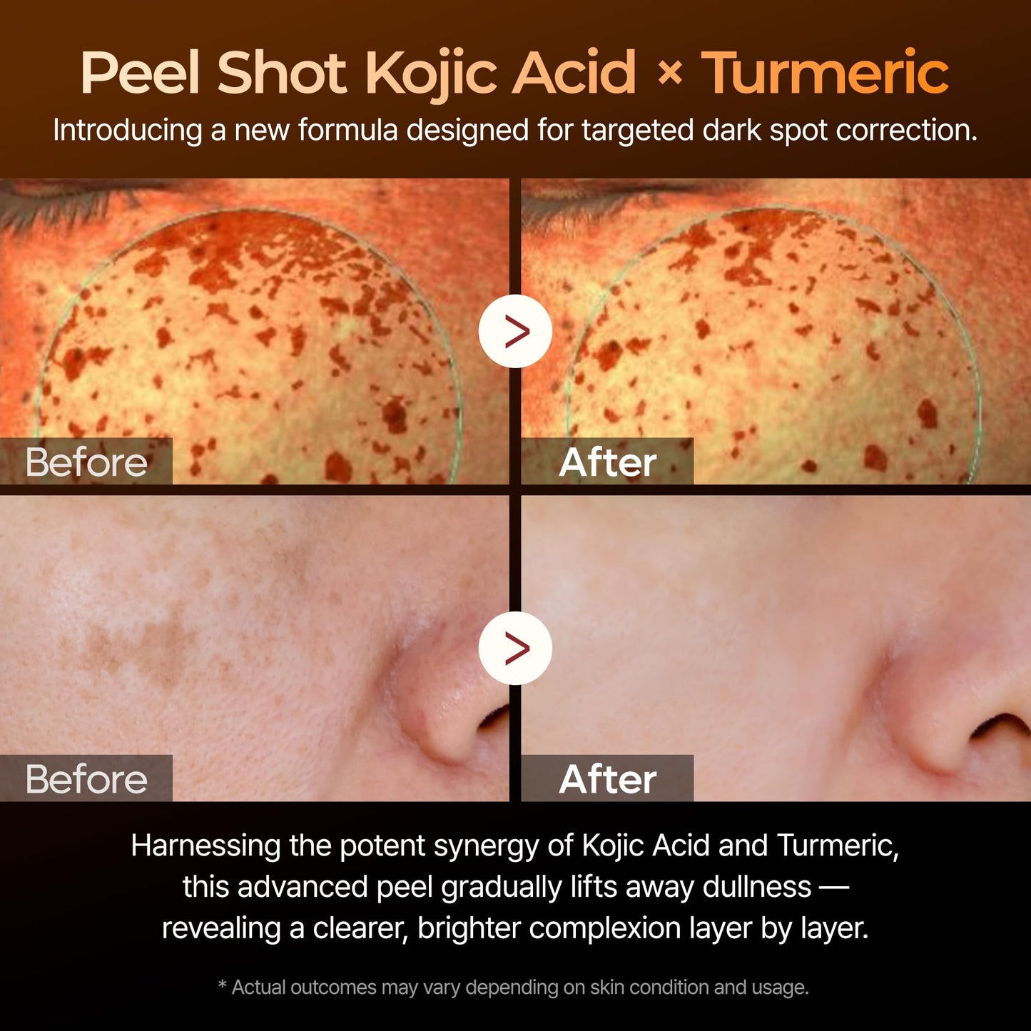 Dr. Melaxin Peel Shot Kojic Acid Turmeric Serum – Exfoliating Dark Spot Corrector with AHA/BHA & Niacinamide, Brightening & Even Tone - dailyvitalstore