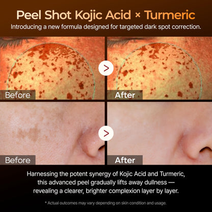 Dr. Melaxin Peel Shot Kojic Acid Turmeric Serum – Exfoliating Dark Spot Corrector with AHA/BHA & Niacinamide, Brightening & Even Tone - dailyvitalstore