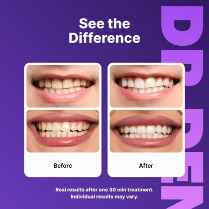 DRDENT Purple Teeth Whitening Strips 21 Treatments - Safe for Enamel - Non Sensitive Teeth Whitening - dailyvitalstore
