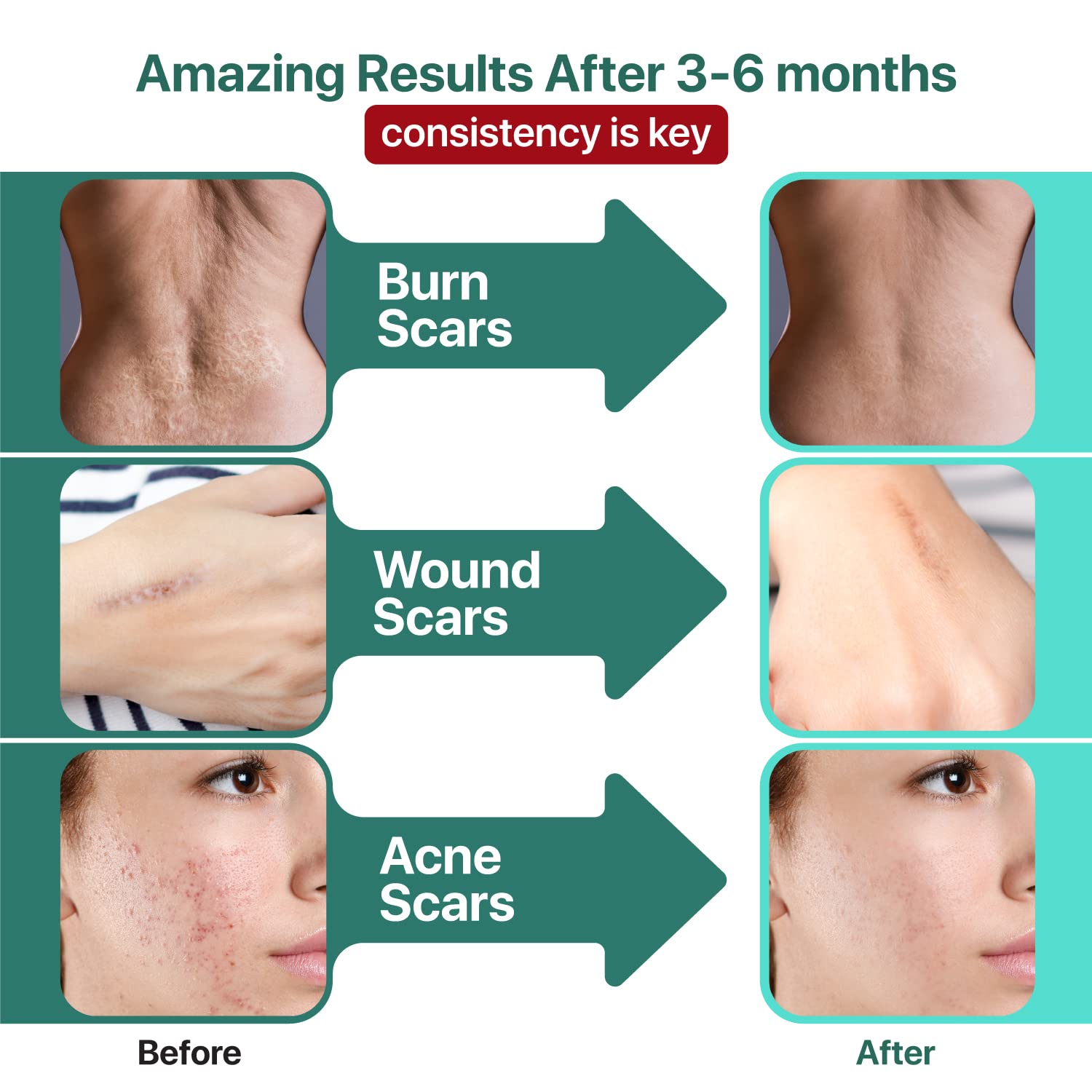 Ebanel Bundle of 30% AHA 2% BHA Chemical Peel and Advanced Silicone Scar Gel - dailyvitalstore
