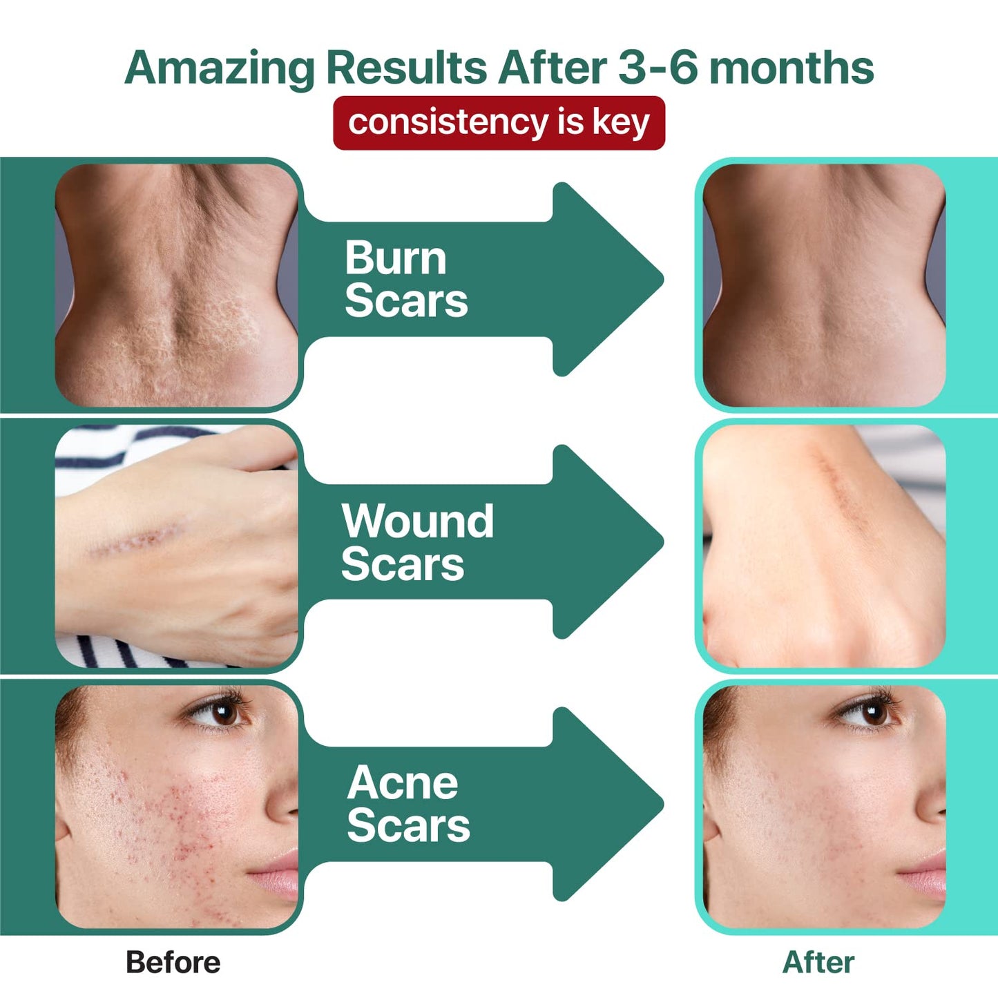 Ebanel Bundle of Advanced Silicone Scar Gel 1 Oz, and Hyaluronic Acid Serum - dailyvitalstore