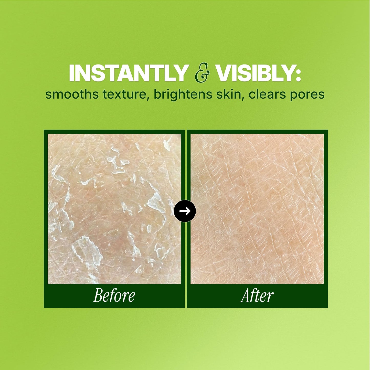 Ebanel Chemical Peel for Face, AHA BHA Exfoliator, Glycolic Acid Peel, Salicylic & Lactic Acid Face Peeling Gel, Infused with Green Tea & Chamomile for Acne Scars, Dark Spots, Wrinkles, Fine Lines - dailyvitalstore
