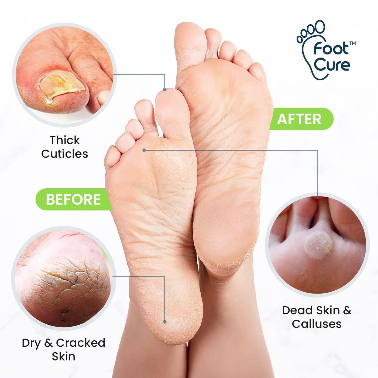 FOOT CURE Exfoliator & Callus Remover Pedicure Set – Care Kit Includes File for Dead Skin, Tea Tree Oil Soak Salts, Urea Cream 40 Percent Removal Gel Made in USA, 4 Piece - dailyvitalstore