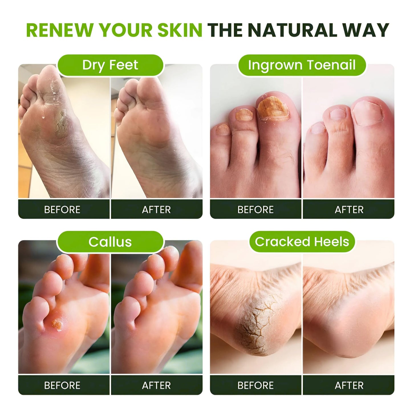 FOOT CURE Tea Tree Oil Foot Soak with Epsom Salt - Best Toenail Fungus Treatment, Athletes Foot & Softens Calluses - Soothes Sore & Tired Feet, Fungal Toe, Foot Odor Scent, Spa Pedicure (Pack of 2) - dailyvitalstore