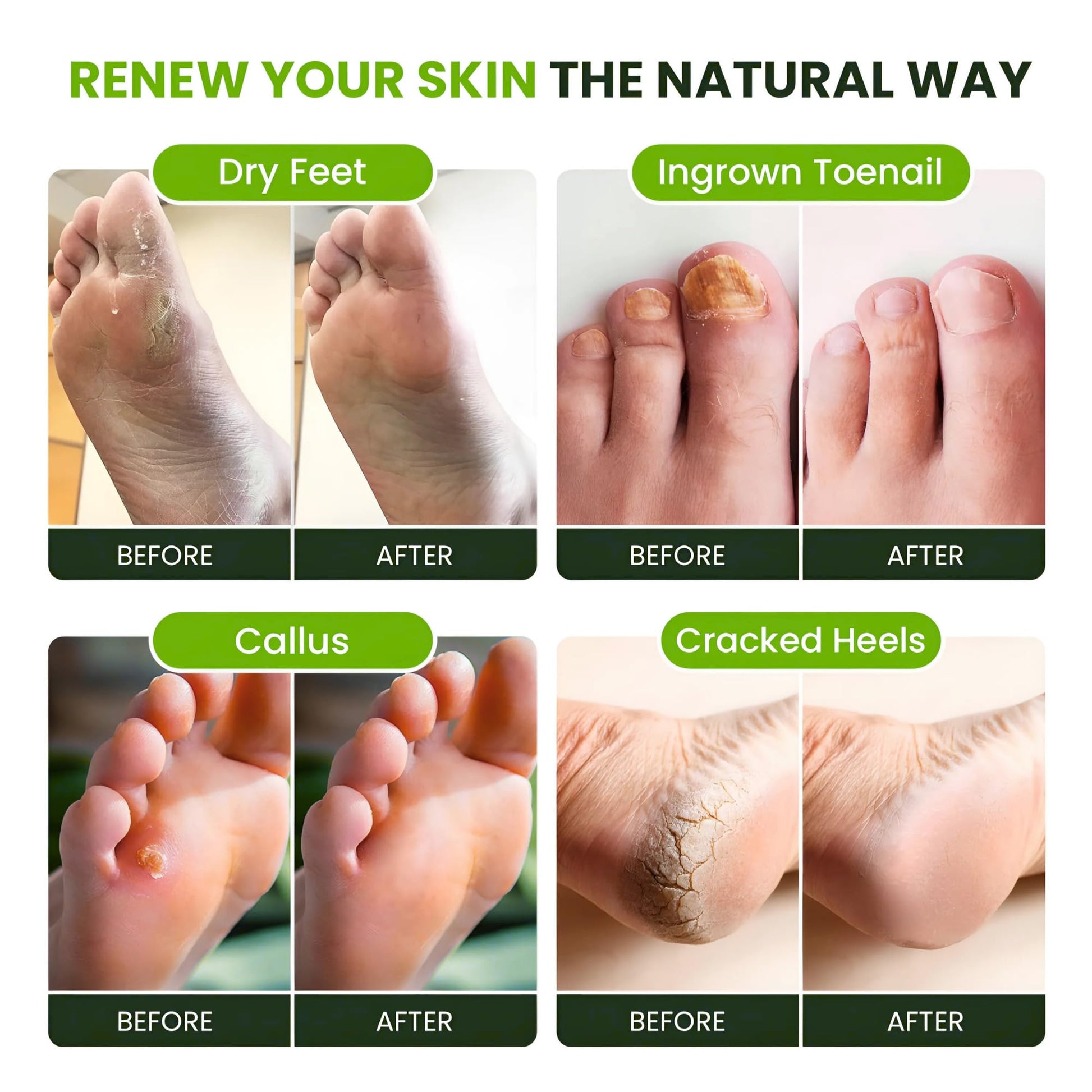FOOT CURE Tea Tree Oil Foot Soak with Epsom Salt - Best Toenail Fungus Treatment, Athletes Foot & Softens Calluses - Soothes Sore & Tired Feet, Fungal Toe, Foot Odor Scent, Spa Pedicure (Pack of 2) - dailyvitalstore