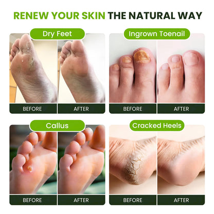 FOOT CURE Tea Tree Oil Foot Soak with Epsom Salt - Best Toenail Fungus Treatment, Athletes Foot & Softens Calluses - Soothes Sore & Tired Feet, Fungal Toe, Foot Odor Scent, Spa Pedicure (Pack of 2) - dailyvitalstore
