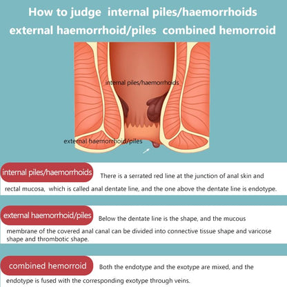 Hemorrhoid Cream for Men and Women, with Lidocaine and Phenylephrine HCl, Provides Fast Relief from hemorrhoid discomfort. Naturally formulated for Hemorrhoids and fissures (0.7 oz) - dailyvitalstore
