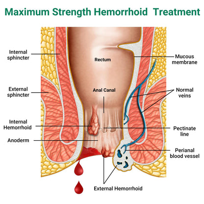 Hemorrhoid Treatment Ointment, Maximum Strength Treatment & Fast Relief for Pain, Itching, Burning, Swelling, Fissure, Bleeding, Discomfort, Long-Lasting Internal & External Hemorrhoid Cream, (2-Pack) - dailyvitalstore