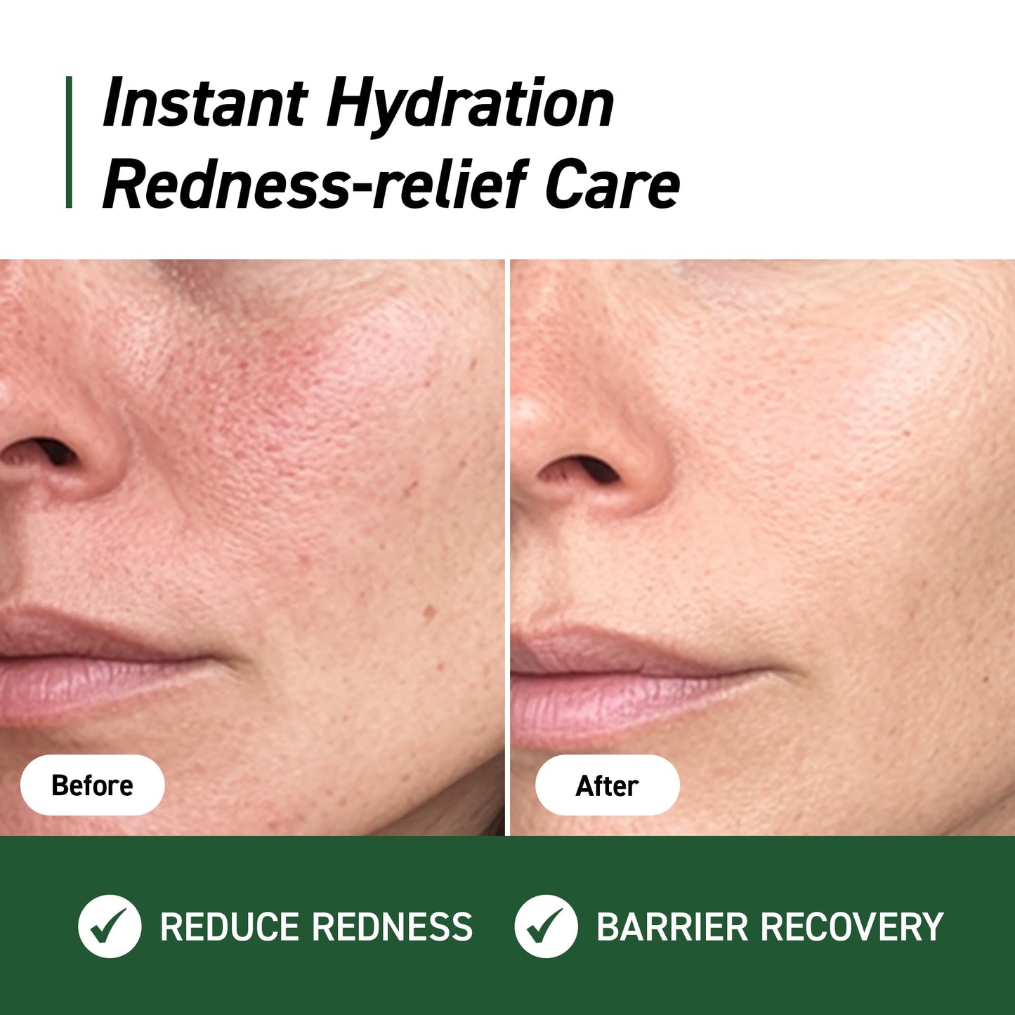 IVOSKIN Cica Redness Relief Treatment Cream, Soothing & Hydrating Green Correcting Moisturizer with Madecassoside, Helps Repair Skin Barrier for Sensitive Skin - dailyvitalstore