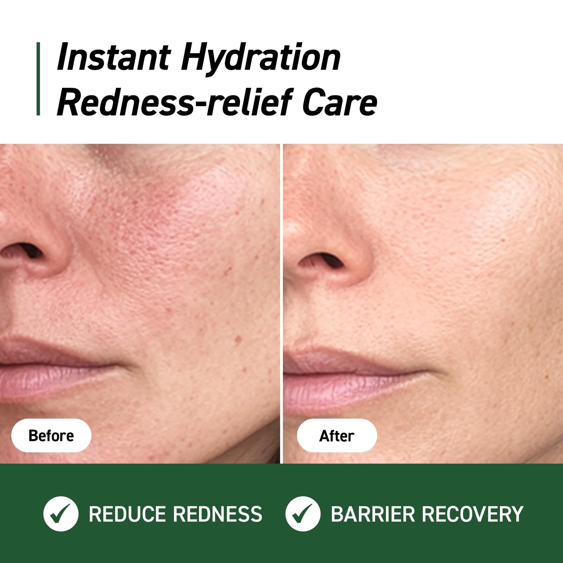IVOSKIN Cica Redness Relief Treatment Cream, Soothing & Hydrating Green Correcting Moisturizer with Madecassoside, Helps Repair Skin Barrier for Sensitive Skin - dailyvitalstore