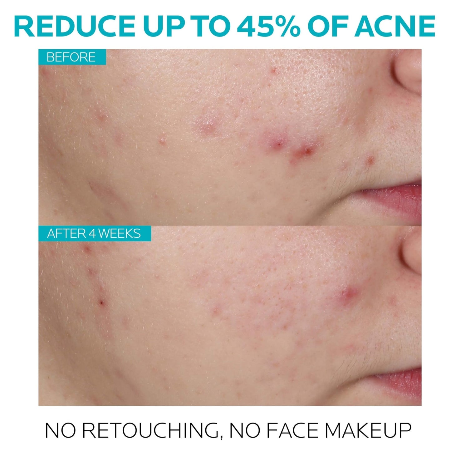 La Roche-Posay Effaclar Salicylic Acid Treatment to Minimize Pores, Clear Acne Blemishes and Post Acne Marks - dailyvitalstore