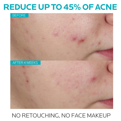 La Roche-Posay Effaclar Salicylic Acid Treatment to Minimize Pores, Clear Acne Blemishes and Post Acne Marks - dailyvitalstore