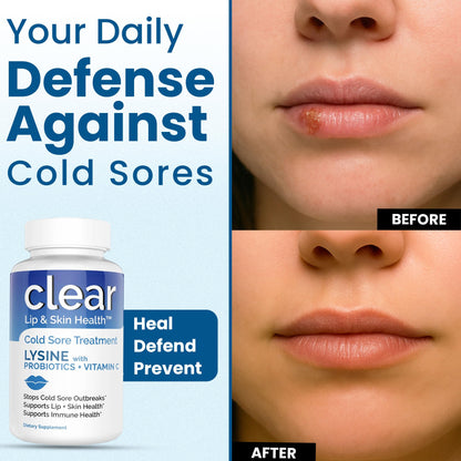 Lysine Cold Sore Treatment for Lips with Pre-Probiotics & VIT C | 1 Month Supply | Supercharged Lysine Capsules with Rhamnosus & Acidophilus for Cold Sores Relief - dailyvitalstore