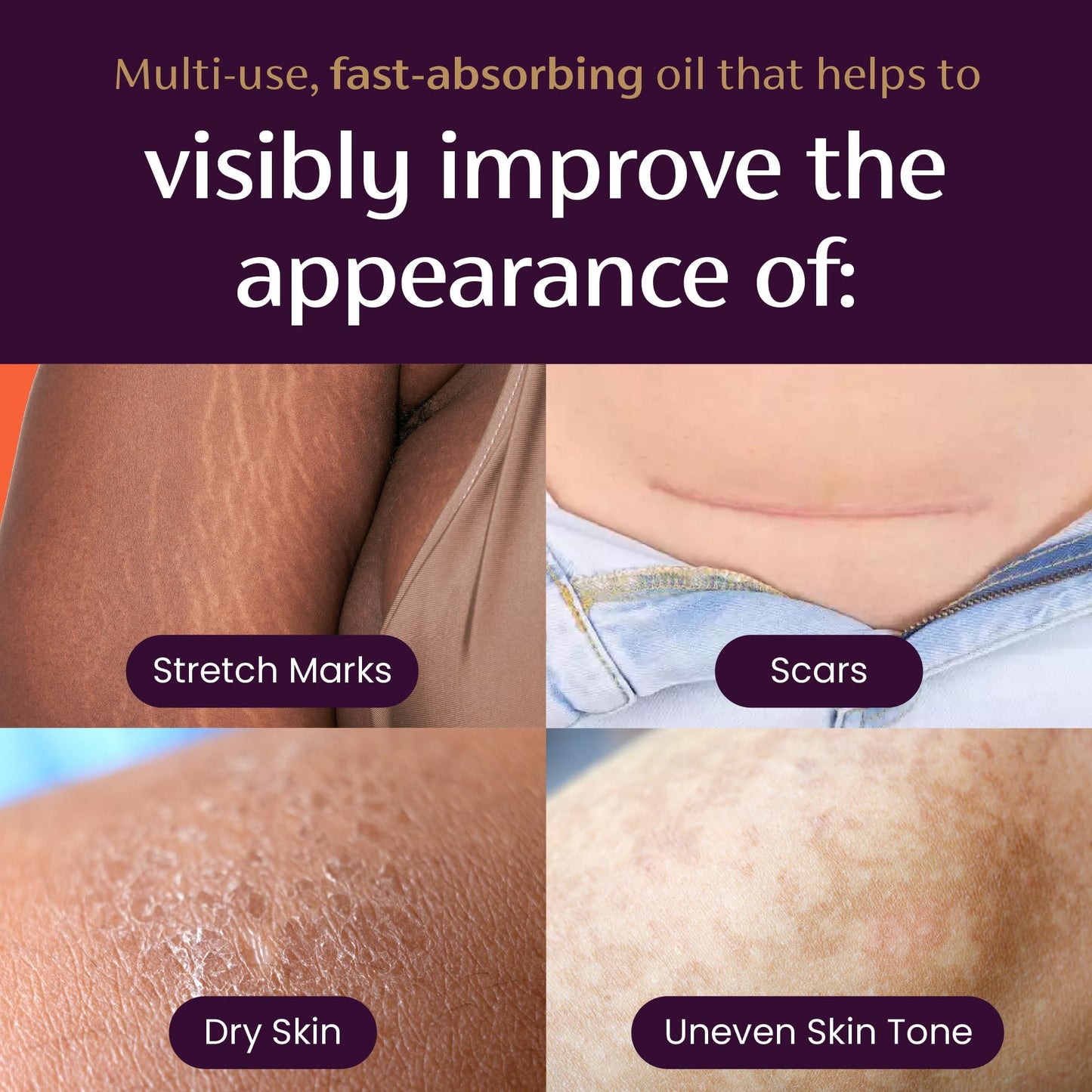 Mederma Quick Dry Oil, Scar and Stretch Mark Treatment, Helps to Improve the Appearance with Natural Botanical Extracts, Paraben Free, Fast-Absorbing, 3.4oz (100ml) - dailyvitalstore