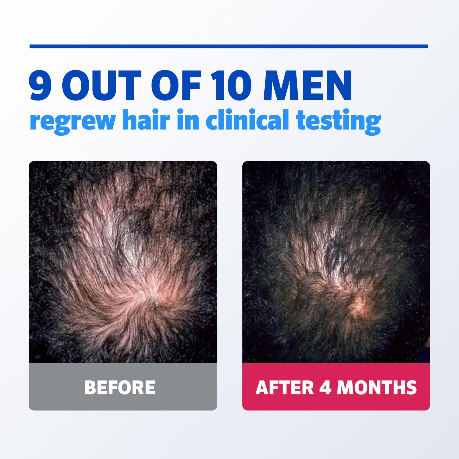 Men’s Rogaine 5% Minoxidil for Men Foam, Clinically Proven Regrowth for Thinning Hair, Topical Hair Loss Treatment, Unscented Topical Aerosol, Results in 8–16 Weeks - dailyvitalstore