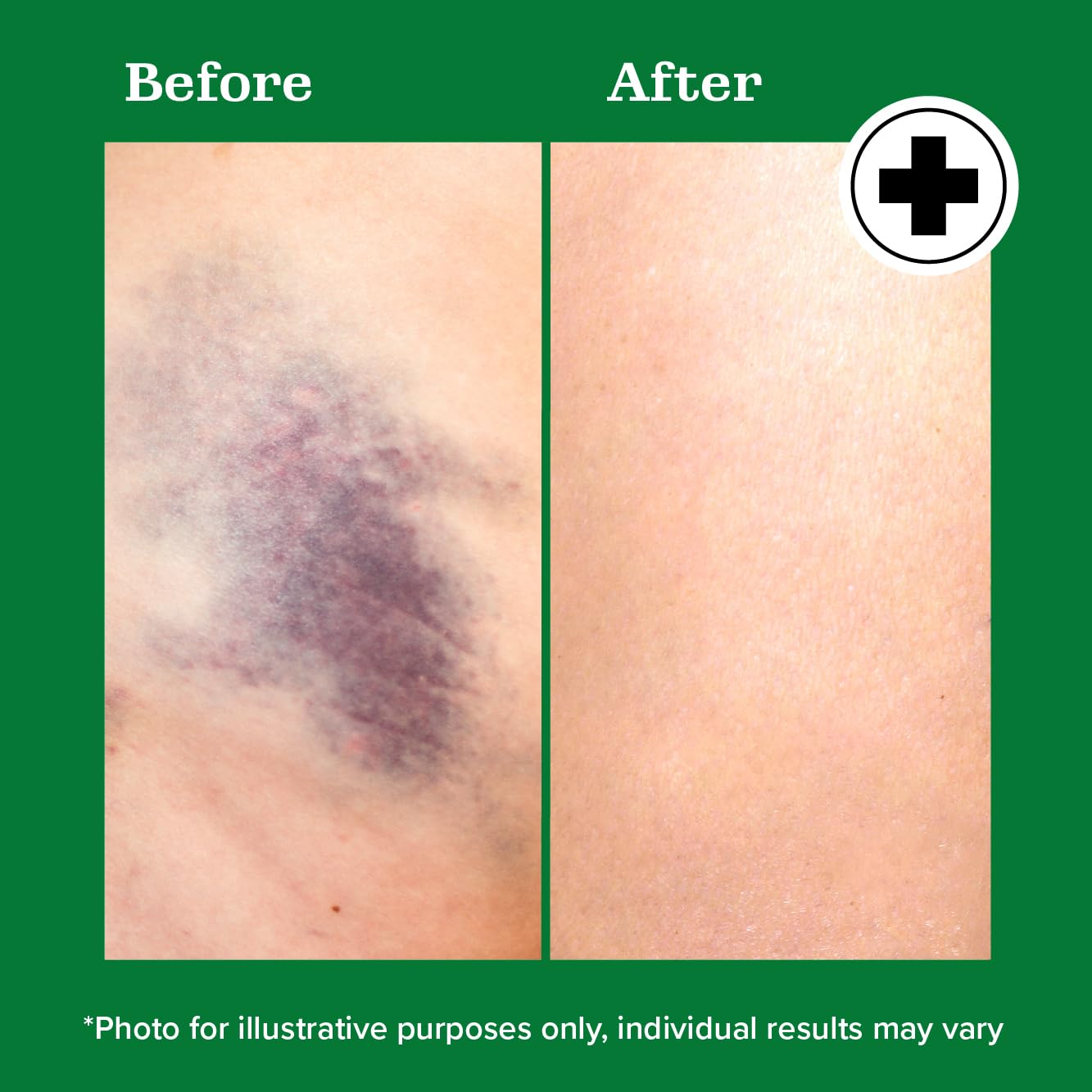 Miracle Plus Arnica Bruise Relief Gel + Magnesium Leg Relief Cream Bundle - dailyvitalstore