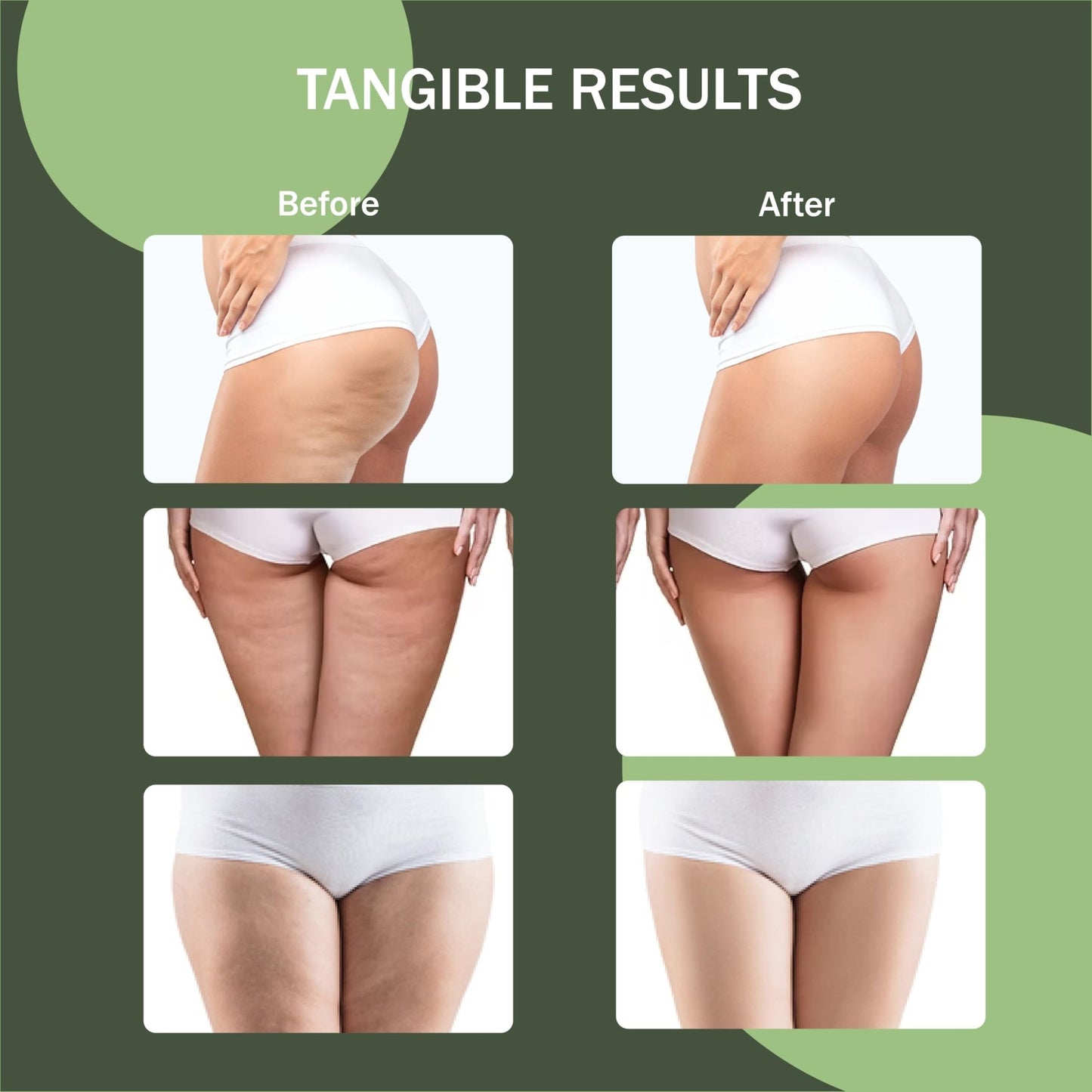 Osmibe Cellulite Manual Massager - Lymphatic Drainage Massager with Detachable Handles - Reduce Cellulite and Stretch Marks on Legs and Body - dailyvitalstore