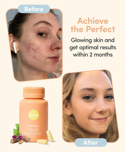 Ovira Skin Clear with ZINCBRIGHT - 60 Capsules for Clear and Glowing Skin | Rosacea & Hormonal Acne Treatment | Support Collagen Production | Acne Supplements for Women & Men - Pack of 2 - dailyvitalstore