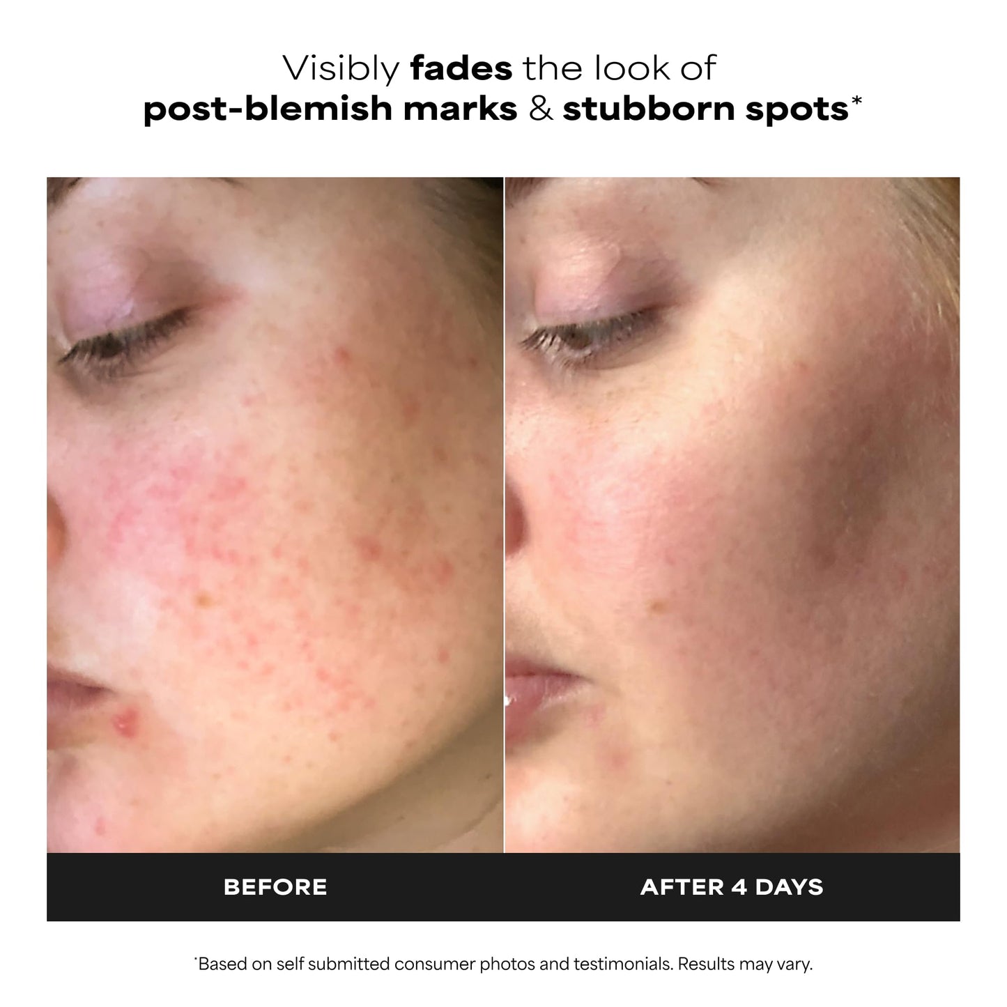 Paula’s Choice BOOST 10% Azelaic Acid Booster Cream Gel, Oil-Free Serum Fades Discoloration & Post-Blemish Marks, with Licorice Extract - dailyvitalstore