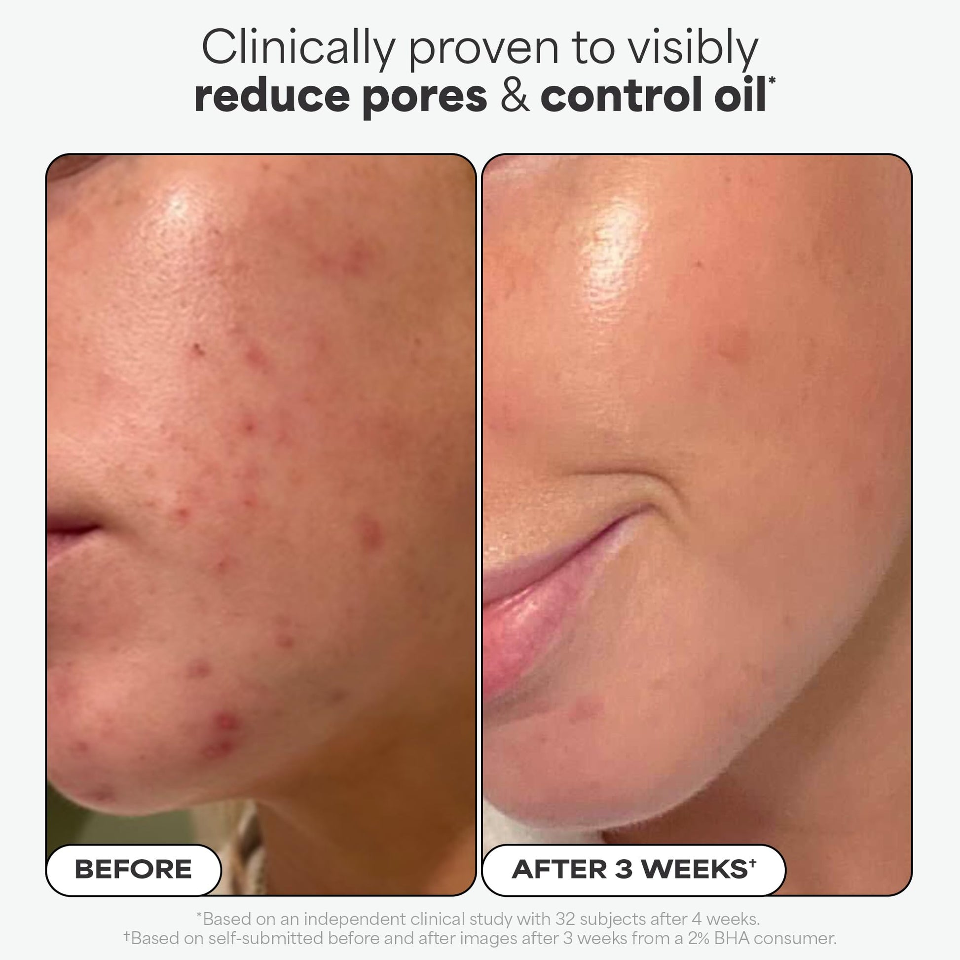 Paulas Choice - SKIN PERFECTING 2% BHA Liquid Salicylic Acid Exfoliant - Facial Exfoliant for Blackheads, Enlarged Pores, Wrinkles & Fine Lines, 4 oz Bottle - dailyvitalstore