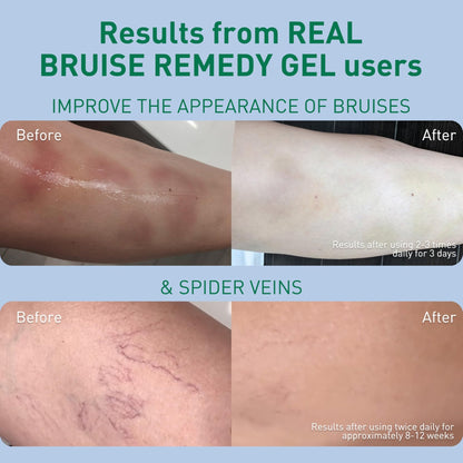 PROcure Arnica & MSM Bruise Remedy Gel – Paraben-Free, Unscented Arnica Montana Gel for Bruising, Spider Veins & Skin Discoloration – 2 Pack - dailyvitalstore
