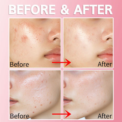 Purederm Blemish Spot Treatment Gel with Salicylic Acid 2%, Soothing Acne Care for Irritated Skin, Day & Night Use, 20ml - dailyvitalstore