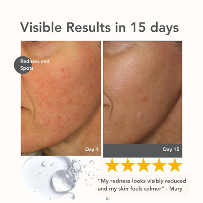 Riversol Rosacea Treatment for Face | Anti-Redness Serum for Sensitive Skin | Calming Redness Relief | Vitamin C & E | Anti-Aging Formula | Fragrance Free - dailyvitalstore