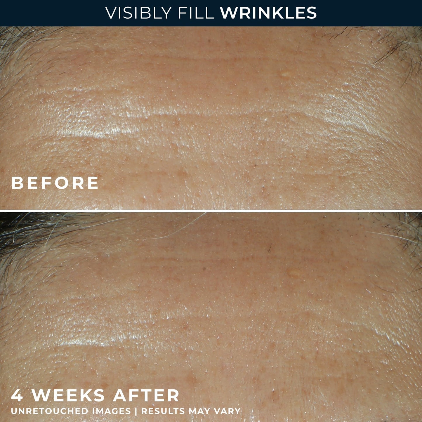 RoC Retinol Correxion Wrinkle Filler for Deep Wrinkles with Hyaluronic Acid & Retinol, Skin Care for Women and Men, - dailyvitalstore