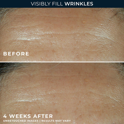 RoC Retinol Correxion Wrinkle Filler for Deep Wrinkles with Hyaluronic Acid & Retinol, Skin Care for Women and Men, - dailyvitalstore
