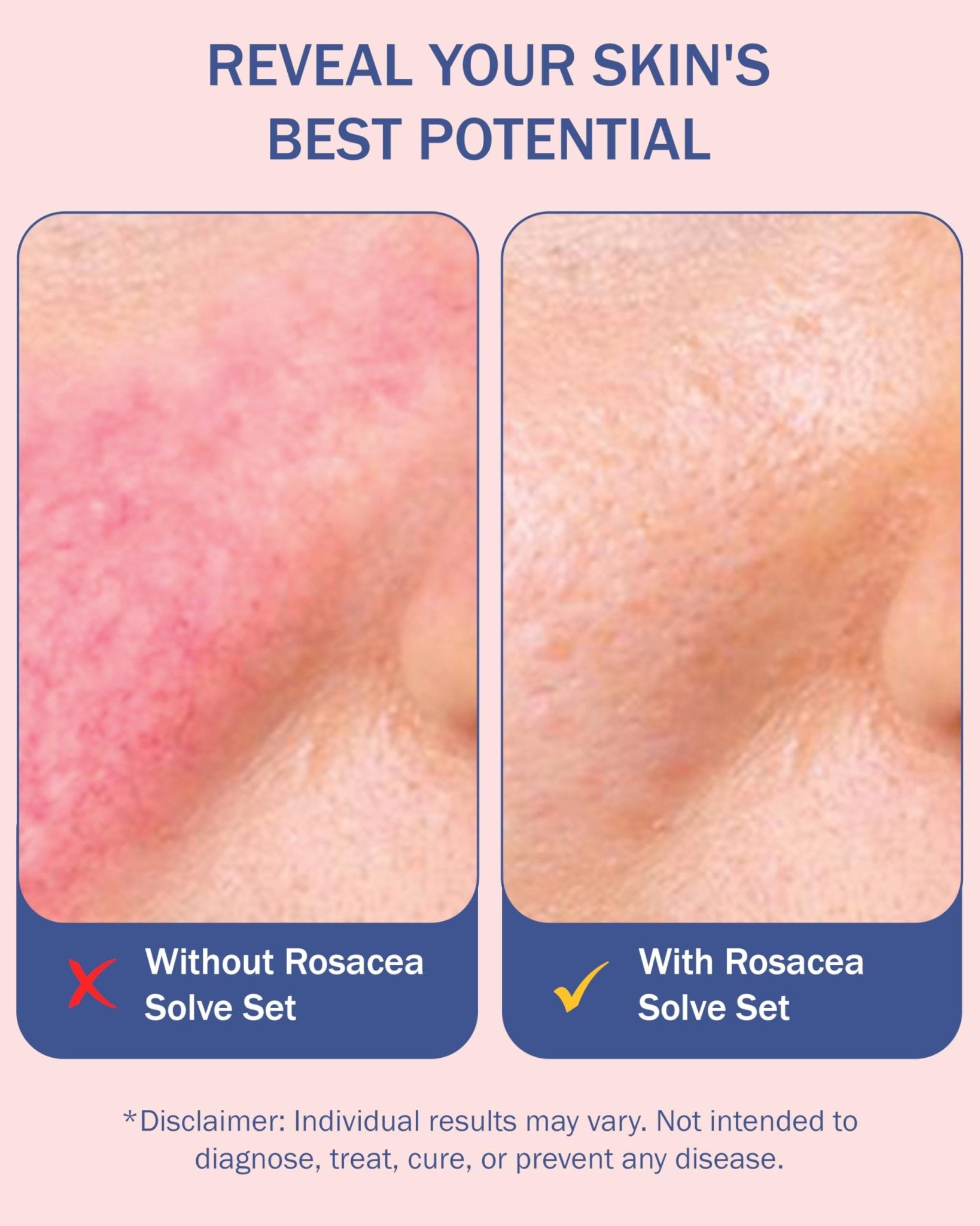 Rosacea Treatment Skincare for Women & Men - Face Wash, Rosacea Cream & Face Serum, Moisturizer Redness Reducing Skin Care with Aloe Vera, - dailyvitalstore
