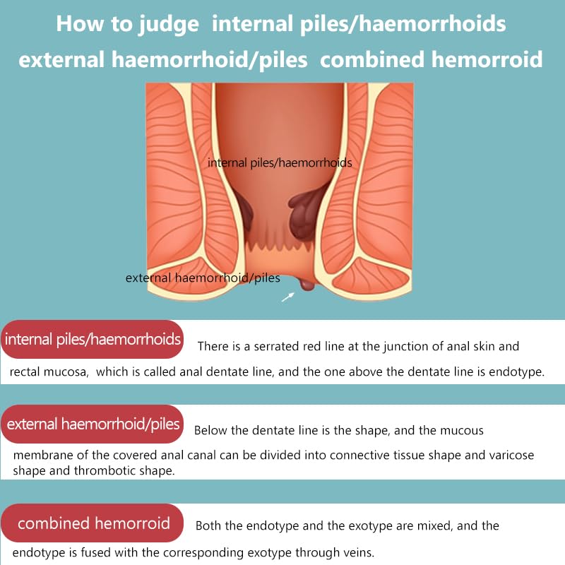SERYNTH Hemorrhoid and Anal Fissure Ointment, Hemorrhoid Treatment, Fast Relief from Swelling, Pain, Itching, Burning (20g) - dailyvitalstore