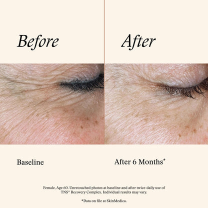 SkinMedica TNS Recovery Complex Facial Treatment - Advanced Growth Factor & Exosome Formula for Skin Rejuvenation - Helps to Improve the Appearance of Fine Lines - dailyvitalstore