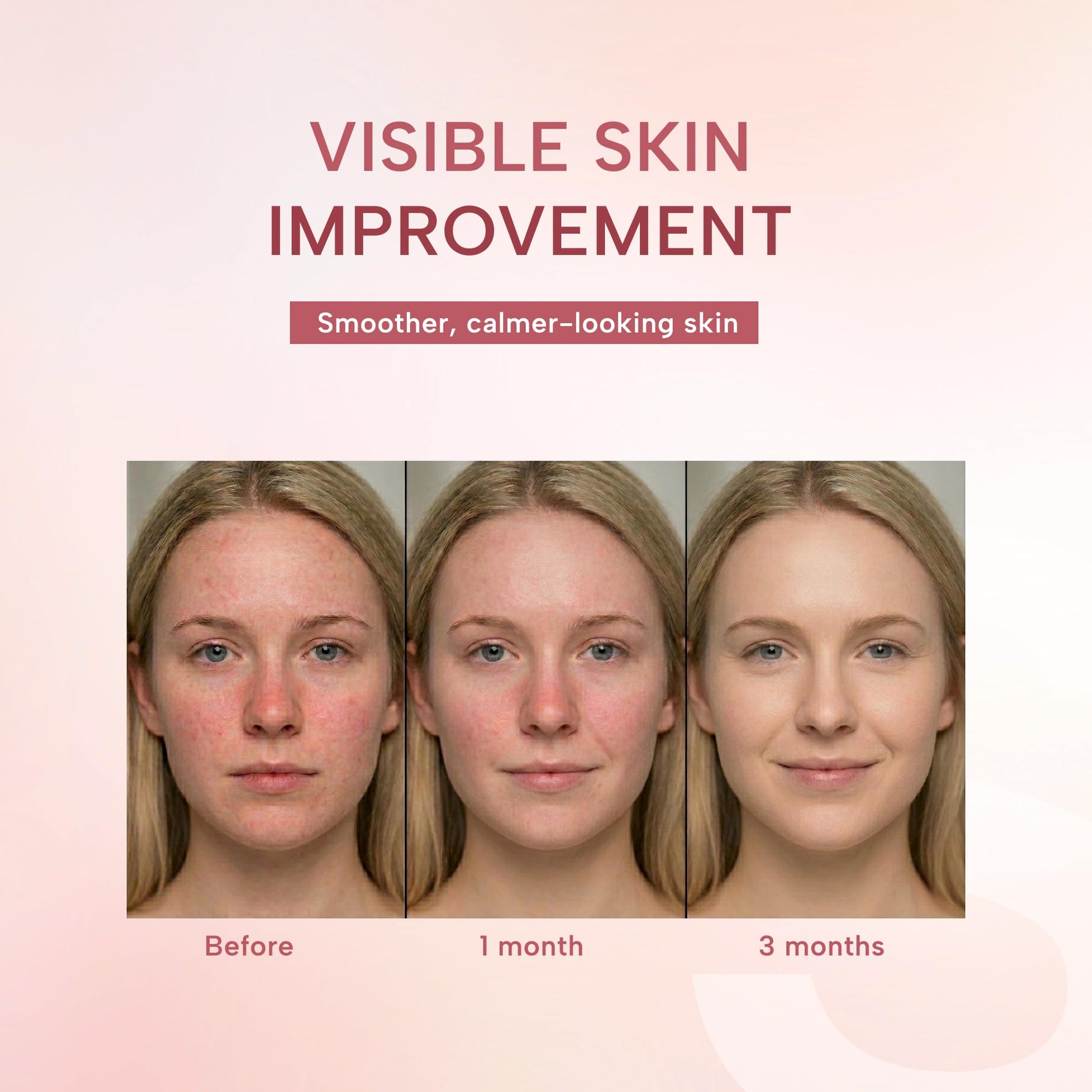 suquato 10% Azelaic Acid Cream – Rosacea Treatment for Face & Redness Reducing Face Cream – Redness & Blemish Care for Sensitive Skin - dailyvitalstore