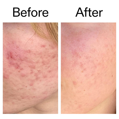 The INKEY List SuperSolutions Azelaic Acid 10% Serum, Fast-Absorbing Formula Helps Reduce Appearance of Redness and Soothes Skin, - dailyvitalstore