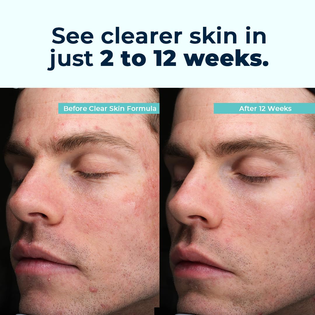 VitaMedica Clear Skin Vitamin Formula | Noncystic Acne Supplement for Skin Clearing | Breakout Treatment for Women and Men | Vitamins A, C, E, Selenium, Chromium, and Zinc for Skin Health | 2 Pack - dailyvitalstore